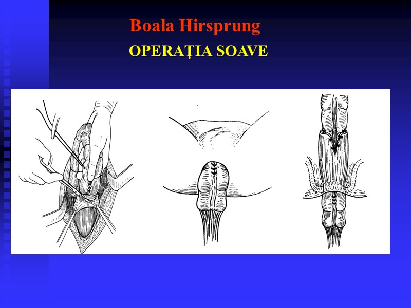 Boala Hirsprung  OPERAŢIA SOAVE